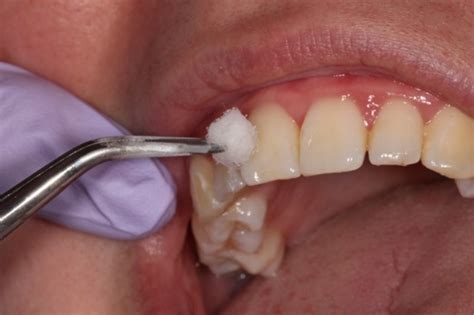 scratch test dental|tooth surface loss test.